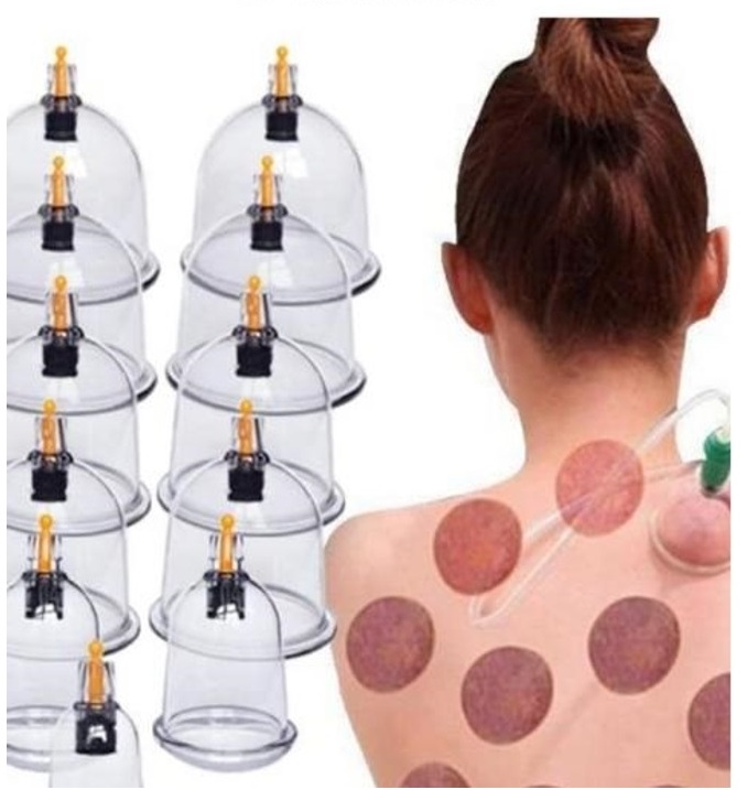 Photo shows Dry Cupping