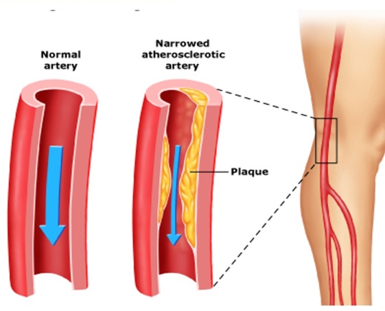 NARROW Vs. Normal Artery Narrow Vs Normal Vessel